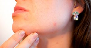 Woman with a skin condition